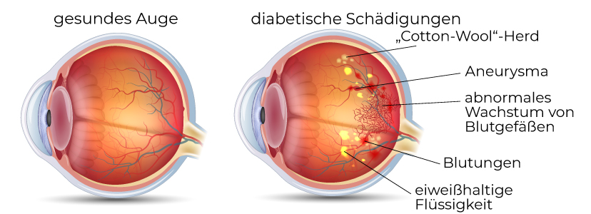 diabetets_illu Veränderungen des Auges bei Diabetes mellitus
