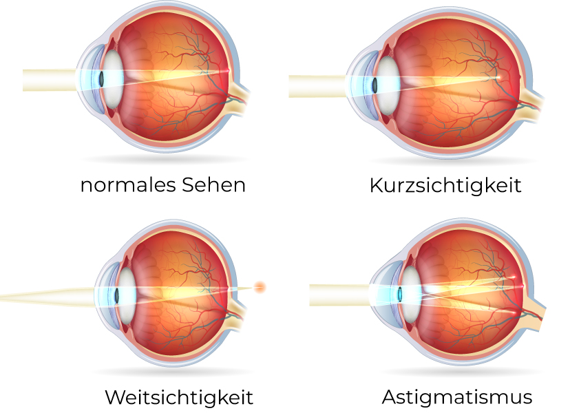fehlsichtigkeiten Fehlsichtigkeiten des Auges