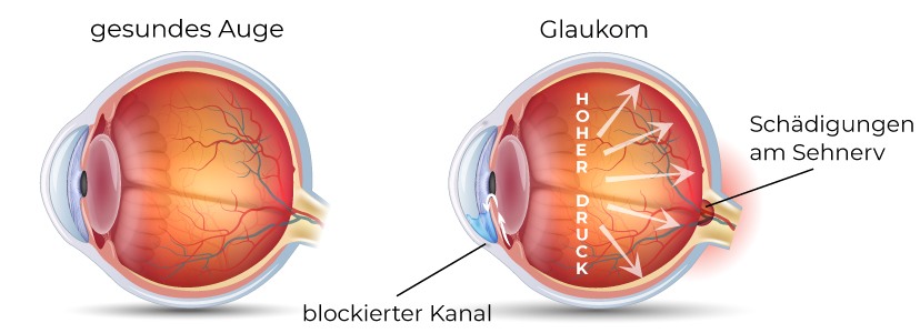 Veränderungen der Auges bei Glaukomen