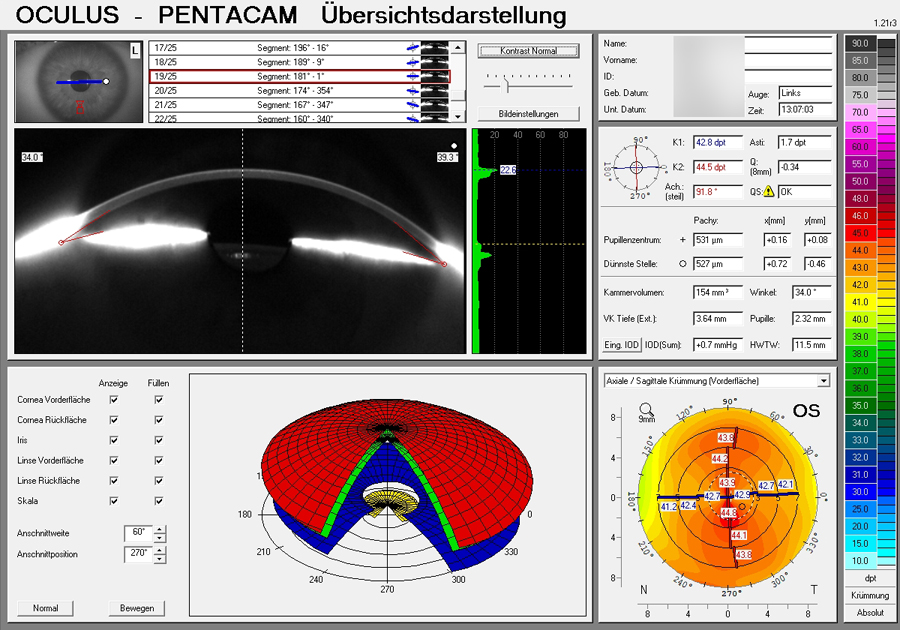 Pentacam
